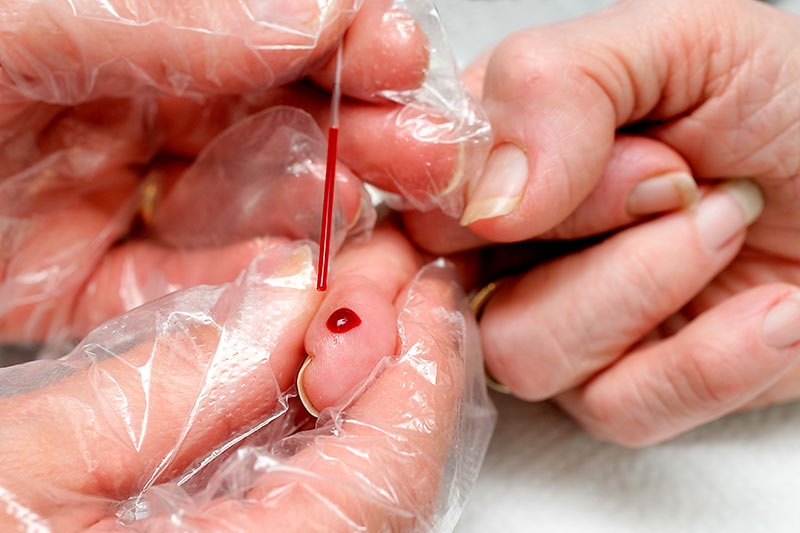 Wie schaut es mit Ihrer Immunität gegen Corona aus? SARS-CoV-2 Labortest auf Antikörper